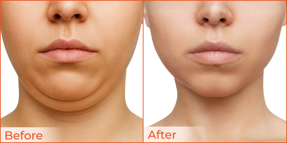 Double Chin & Jawline